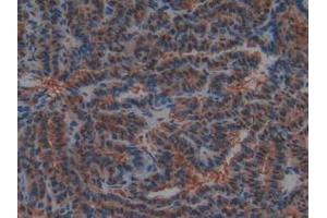 IHC-P analysis of Human Thyroid Cancer Tissue, with DAB staining. (PTF1A 抗体  (AA 177-328))