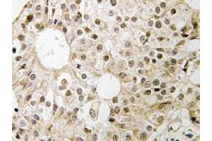 Immunohistochemistry (IHC) analyzes of CD3EAP antibody in paraffin-embedded human breast carcinoma tissue. (CD3EAP 抗体)