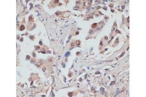 Immunohistochemistry of paraffin-embedded Human lung cancer using TES Polyclonal Antibody at dilution of 1:100 (40x lens). (TES 抗体)