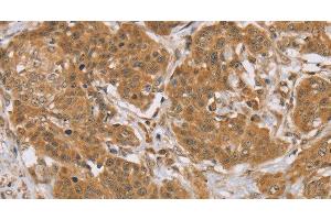 Immunohistochemistry of paraffin-embedded Human cervical cancer tissue using KCNJ15 Polyclonal Antibody at dilution 1:40 (KCNJ15 抗体)