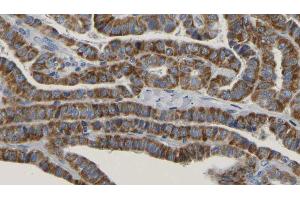 ABIN6267170 at 1/100 staining Human thyroid cancer tissue by IHC-P.