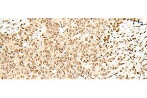 Immunohistochemistry of paraffin-embedded Human ovarian cancer tissue using FKBP5 Polyclonal Antibody at dilution of 1:50(x200) (FKBP5 抗体)