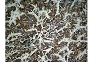 Immunohistochemical analysis of paraffin-embedded human lung carcinoma tissue, using β-catenin (phospho-Tyr333) Antibody.