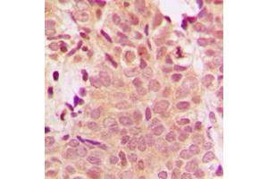 Immunohistochemical analysis of Histone Deacetylase 5 staining in human breast cancer formalin fixed paraffin embedded tissue section. (HDAC5 抗体  (Center))