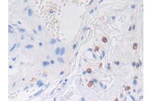Detection of LRP1 in Human Stomach cancer Tissue using Polyclonal Antibody to Low Density Lipoprotein Receptor Related Protein 1 (LRP1) (LRP1 抗体  (AA 4441-4544))