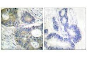 Immunohistochemical analysis of paraffin-embedded human colon carcinoma tissue using 4E-BP1 (Ab-64) antibody.