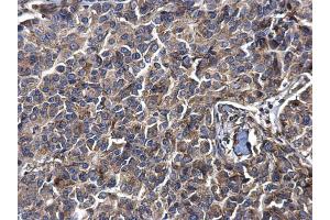 IHC-P Image LYRIC antibody [N2C3] detects LYRIC protein at cytosol on human breast carcinoma by immunohistochemical analysis. (MTDH 抗体)