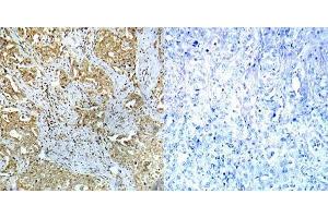 Immunohistochemical analysis of paraffin-embedded human breast carcinoma tissue using Abl1 (phospho- Tyr412) antibody (E012002). (ABL1 抗体  (pTyr412))