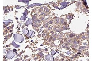 ABIN6267428 at 1/100 staining human breast carcinoma tissue sections by IHC-P. (NFKB1 抗体  (pSer927))