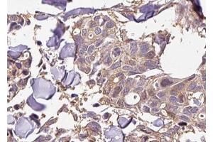 ABIN6267428 at 1/100 staining human breast carcinoma tissue sections by IHC-P.
