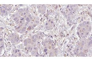 ABIN6273951 at 1/100 staining Human liver cancer tissue by IHC-P.