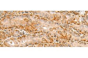 Immunohistochemistry of paraffin-embedded Human thyroid cancer tissue using C3orf38 Polyclonal Antibody at dilution of 1:80(x200) (C3orf38 抗体)