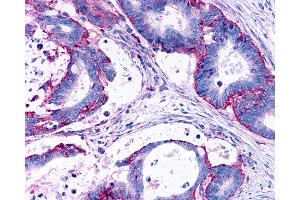 Anti-LPAR3 / LPA3 / EDG7 antibody IHC of human Colon, Carcinoma. (LPAR3 抗体  (Cytoplasmic Domain))