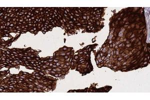 ABIN6268883 at 1/100 staining Human urothelial cancer tissue by IHC-P.