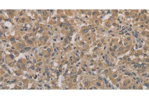 Immunohistochemistry of paraffin-embedded Human thyroid cancer tissue using AGTRAP Polyclonal Antibody at dilution 1:40 (AGTRAP 抗体)