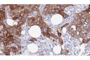 ABIN6272640 at 1/100 staining Human Head and neck cancer tissue by IHC-P. (COLEC12 抗体  (C-Term))