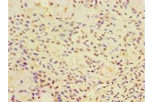 Immunohistochemistry of paraffin-embedded human breast cancer using ABIN7146575 at dilution of 1:100 (Calreticulin 3 抗体  (AA 135-384))