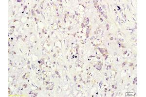 Formalin-fixed and paraffin-embedded human cervical carcinoma labeled with Rabbit Anti-CD160/By55 Polyclonal Antibody ( , Unconjugated at 1:200 followed by conjugation to the secondary antibody and DAB staining (CD160 抗体  (AA 81-159))