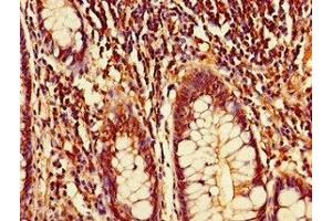 Immunohistochemistry of paraffin-embedded human colon cancer using ABIN7149691 at dilution of 1:100