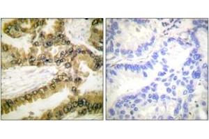 Immunohistochemistry analysis of paraffin-embedded human lung carcinoma, using Akt1 (Phospho-Thr450) Antibody. (AKT1 抗体  (pThr450))