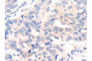 DAB staining on IHC-P; Samples: Human Breast cancer Tissue (IL-7 抗体  (AA 26-177))