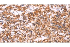 Immunohistochemistry of paraffin-embedded Human thyroid cancer tissue using EMP2 Polyclonal Antibody at dilution 1:30 (EMP2 抗体)