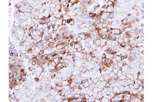IHC-P Image Immunohistochemical analysis of paraffin-embedded CL1-0 xenograft, using GPR86, antibody at 1:500 dilution. (Purinergic Receptor P2Y, G-Protein Coupled, 13 (P2RY13) (Internal Region) 抗体)