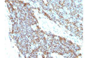 Formalin-fixed, paraffin-embedded human Ewing's sarcoma stained with CD99 Monoclonal Antibody (12E7+MIC2/877). (CD99 抗体)