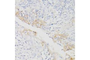 Immunohistochemistry of paraffin-embedded Human chronic tonsillitis using PD-L1/CD274/CD274 Rabbit mAb (ABIN7266181) at dilution of 1:200 (40x lens). (PD-L1 抗体  (Extracellular Domain))