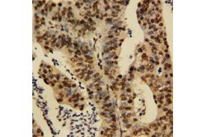Immunohistochemical staining of human rectal cancer tissue with TNFAIP1 polyclonal antibody . (TNFAIP1 抗体  (N-Term))
