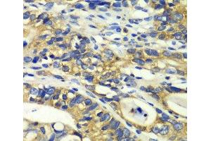 Immunohistochemistry of paraffin-embedded Human colon carcinoma using RPH3A Polyclonal Antibody at dilution of 1:100 (40x lens). (RPH3A 抗体)