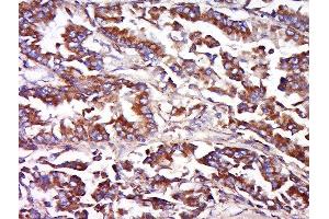 Formalin-fixed and paraffin embedded human lung carcinoma labeled with Anti-FAIM3 Polyclonal Antibody, Unconjugated  at 1:500 followed by conjugation to the secondary antibody and DAB staining.
