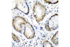 Immunohistochemistry of paraffin-embedded human colon carcinoma using SS18 antibody at dilution of 1:200 (40x lens). (SS18 抗体)