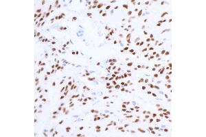 Immunohistochemistry (IHC) image for anti-SRY (Sex Determining Region Y)-Box 10 (SOX10) (AA 416-466) antibody (ABIN7454037) (Recombinant SOX10 抗体  (AA 416-466))