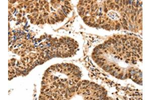 The image on the left is immunohistochemistry of paraffin-embedded Human colon cancer tissue using ABIN7192626(SPATA20 Antibody) at dilution 1/70, on the right is treated with synthetic peptide. (SPATA2 抗体)
