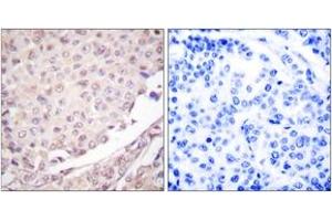 Immunohistochemistry analysis of paraffin-embedded human lung carcinoma tissue, using Cullin 1 Antibody. (Cullin 1 抗体  (AA 727-776))