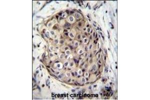 GR Antibody (C-term) (ABIN656814 and ABIN2846028) immunohistochemistry analysis in formalin fixed and paraffin embedded human breast carcinoma followed by peroxidase conjugation of the secondary antibody and DAB staining. (GMPR 抗体  (C-Term))