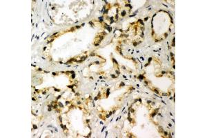 Anti-NAK antibody, IHC(P) IHC(P): Human Prostatic Cancer Tissue (TBK1 抗体  (C-Term))