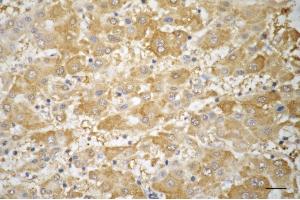 Immunohistochemistry was performed on paraffin-embedded human hepatocarcinoma using TRIM7 antibody (ABIN7800643), 1:200). (TRIM7 抗体)