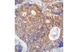 Immunohistochemistry analysis in formalin fixed and paraffin embedded human colon carcinoma reacted with PAICS Antibody (N-term) followed which was peroxidase conjugated to the secondary antibody and followed by DAB staining. (PAICS 抗体  (N-Term))