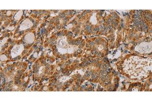 Immunohistochemistry of paraffin-embedded Human thyroid cancer using MTFR1 Polyclonal Antibody at dilution of 1:40 (MTFR1 抗体)