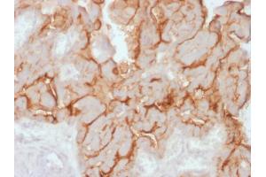 Formalin-fixed, paraffin-embedded human Ovarian Carcinoma stained with MUC16 Rabbit Recombinant Monoclonal Antibody (OCA125/2349R). (Recombinant MUC16 抗体)