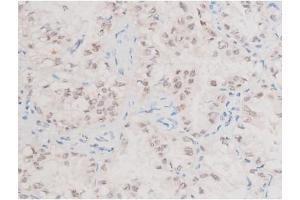ABIN6267577 at 1/200 staining Human lung cancer tissue sections by IHC-P. (XIAP 抗体  (pSer87))