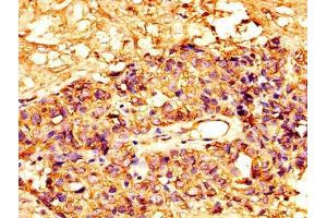 IHC image of ABIN7159428 diluted at 1:300 and staining in paraffin-embedded human ovarian cancer performed on a Leica BondTM system. (Mesothelin 抗体  (AA 37-598))