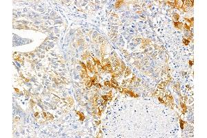 ABIN6259690 and ABIN6266757 at 1/100 staining Human liver cancer by IHC-P. (ABCF1 抗体  (C-Term))