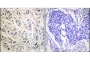 Immunohistochemistry analysis of paraffin-embedded human breast carcinoma tissue, using p90 RSK (Ab-573) Antibody.