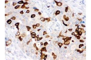 Anti- RRM2 Picoband antibody, IHC(P) IHC(P): Human Mammary Cancer Tissue (RRM2 抗体  (N-Term))