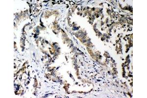IHC-P: PLK2 antibody testing of human lung cancer tissue (PLK2 抗体  (C-Term))