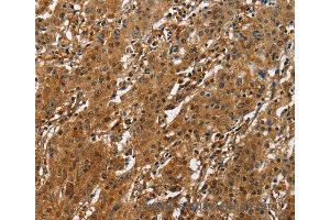 Immunohistochemistry of Human liver cancer using ATF4 Polyclonal Antibody at dilution of 1:50 (ATF4 抗体)