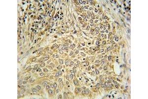 AHR antibody immunohistochemistry analysis in formalin fixed and paraffin embedded human lung carcinoma. (Aryl Hydrocarbon Receptor 抗体  (AA 555-582))